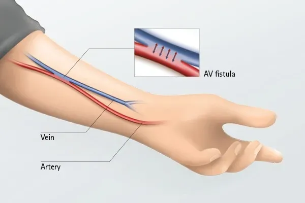 AV fistula