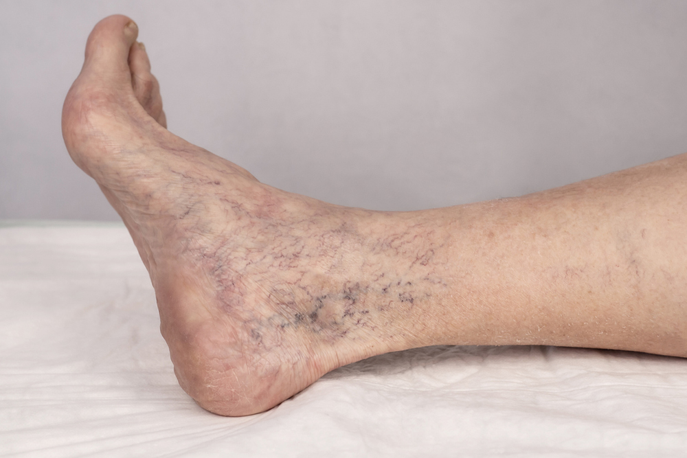 Varicose Veins