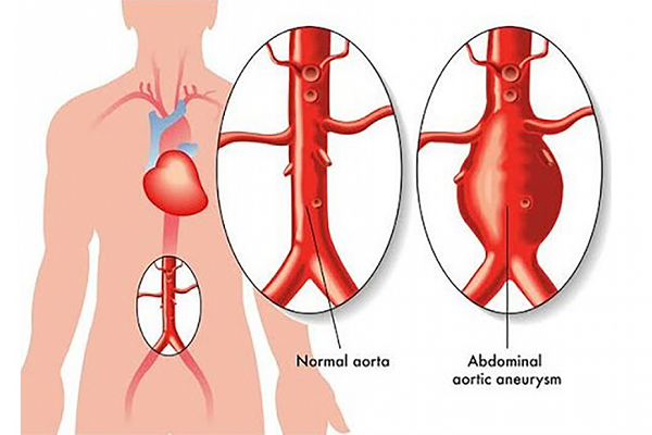 Aortic Aneurysms