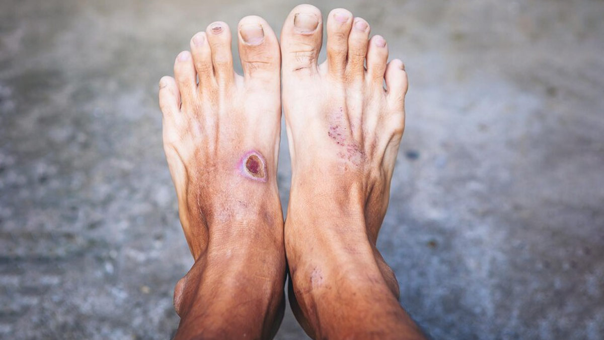 Diabetic Foot Ulcers