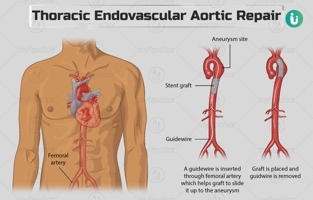 Thoracic Endovascular Aortic Repair (TEVAR)