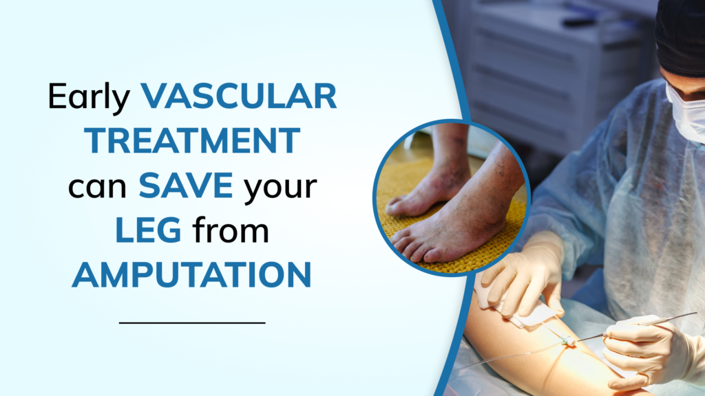Diabetic Foot, Gangrene & Limb Salvage in Delhi