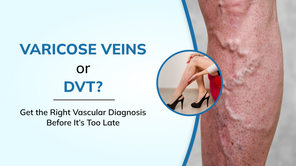 Varicose Veins or DVT? Delhi’s Most Misdiagnosed Vascular Conditions — And Why Getting It Wrong Is Dangerous