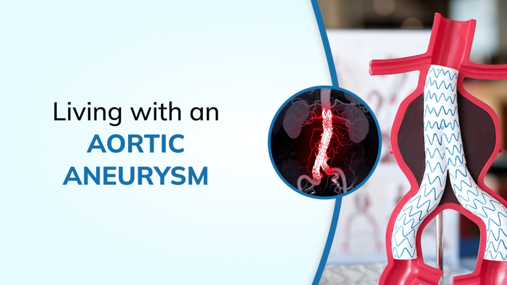 Living with an Aortic Aneurysm: Monitoring, Risks, and When Surgery Becomes Necessary