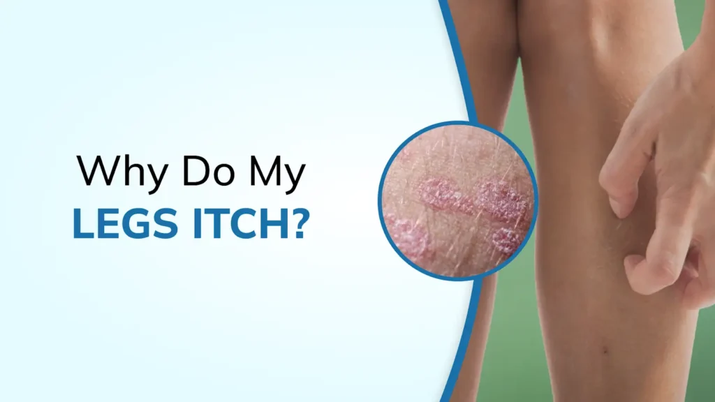 Why Do My Legs Itch Before Varicose Veins Become Visible?