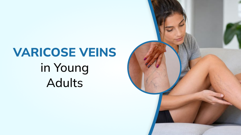 Can Young Adults Get Varicose Veins? Causes, Genetics & Prevention in Your 20s and 30s