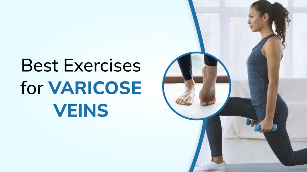 Is Walking Good for Varicose Veins? Best Exercises Recommended by Vascular Surgeons