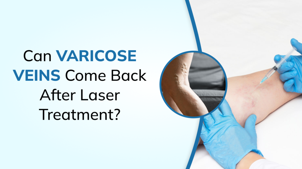 Can Varicose Veins Come Back After Laser Treatment? Everything You Need to Know