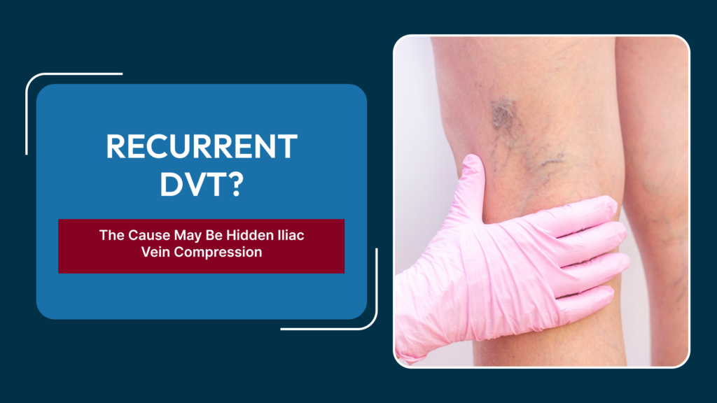 May-Thurner Syndrome and Recurrent DVT: When Should You Consult a DVT Specialist in Delhi for Hidden Iliac Vein Compression?