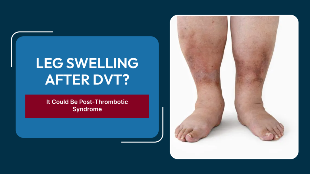 Thrombotic Syndrome After DVT: Why Leg Swelling and Pain Can Continue Even After Successful DVT Treatment