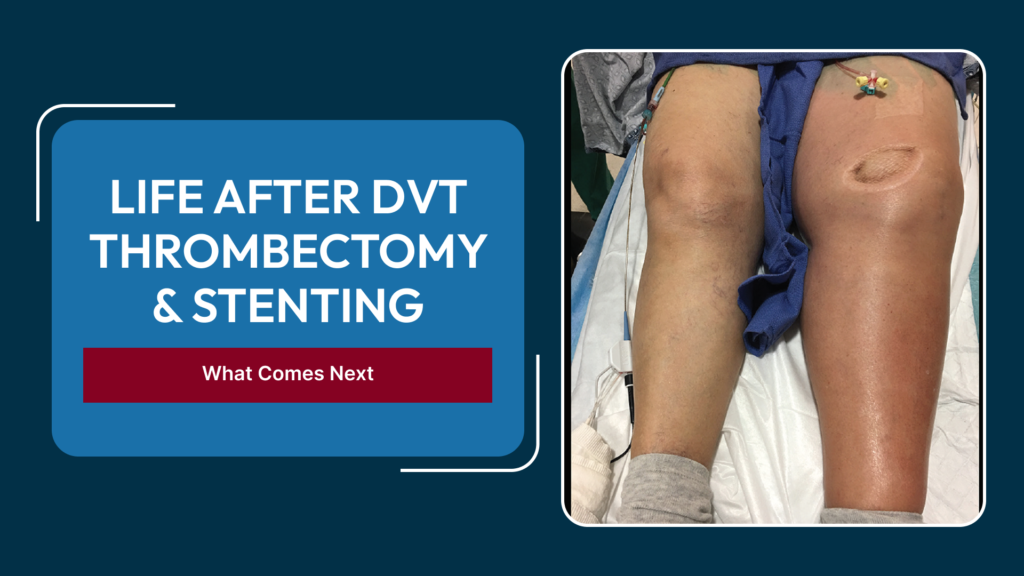 Life After DVT Thrombectomy and Venous Stenting: Follow-Up Scans, Blood Thinners, Travel and Persistent Leg Swelling