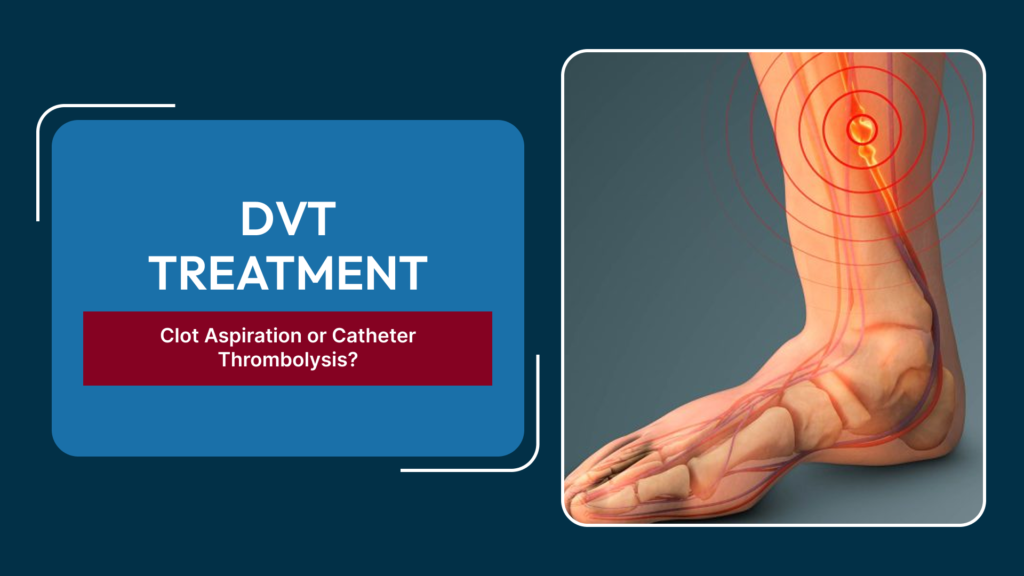 Catheter-Directed Thrombolysis vs Clot Aspiration for DVT: How Treatment Is Selected