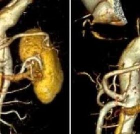 Before and after results in vascular surgery gallery – Dr. Nikhil Chaudhari, Delhi