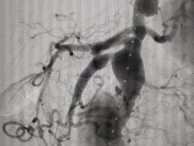 Before and after results in vascular surgery gallery – Dr. Nikhil Chaudhari, Delhi