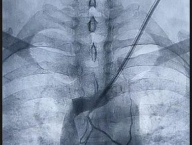 Before and after results in vascular surgery gallery – Dr. Nikhil Chaudhari, Delhi