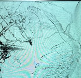 Before and after results in vascular surgery gallery – Dr. Nikhil Chaudhari, Delhi