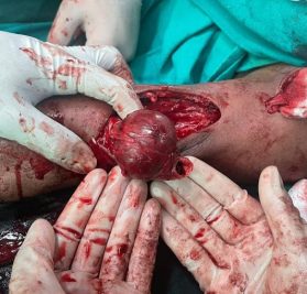 Before and after results in vascular surgery gallery – Dr. Nikhil Chaudhari, Delhi