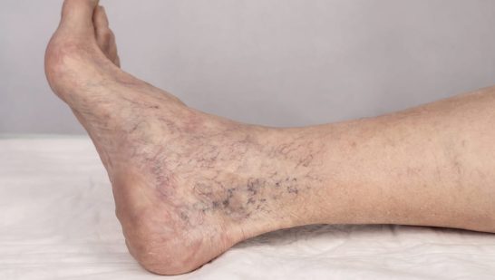 Best Vascular Surgeon In Delhi