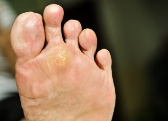 wart under foot can treatment by salicylic acid, blurry background